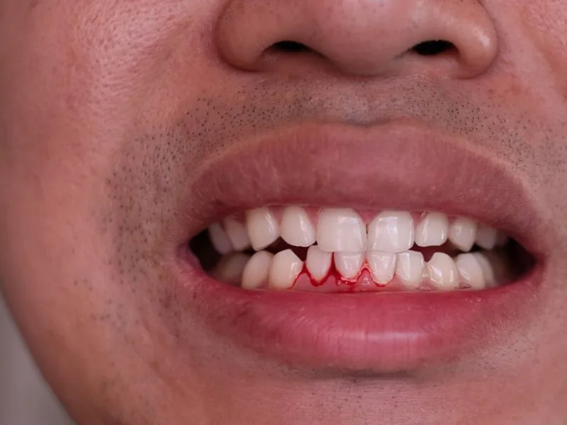 chay mau chan rang do dau 7 nguyen nhan thuong gap